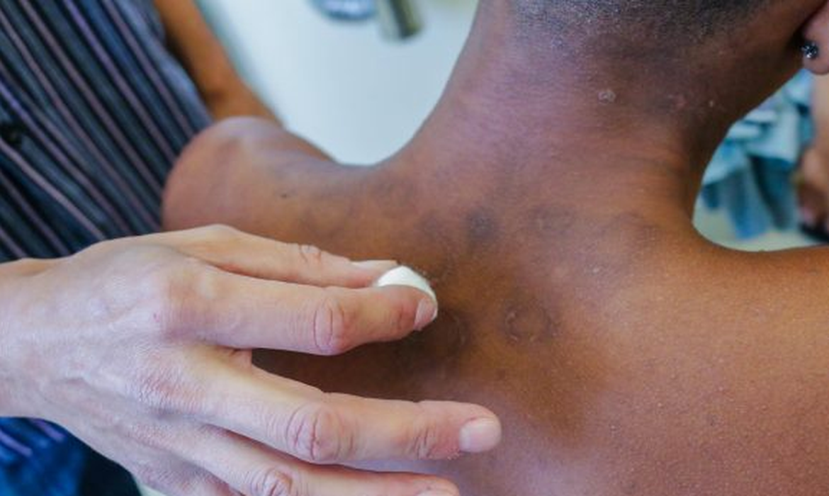 Dependência de doações ameaça tratamento de hanseníase no país